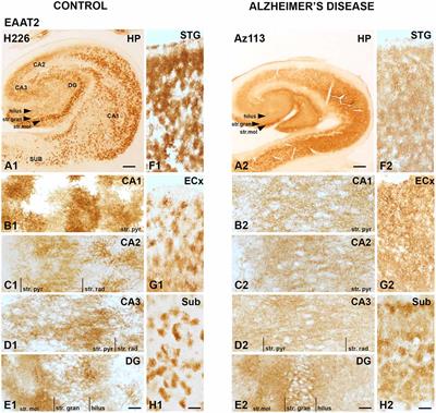 EAAT2 Expression in the Hippocampus, Subiculum, Entorhinal Cortex and Superior Temporal Gyrus in Alzheimer’s Disease